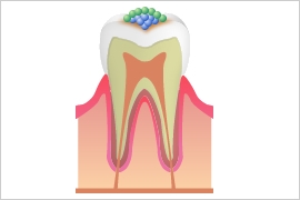 歯のカルシウムが溶け出す（脱灰） 