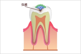 歯が溶ける 